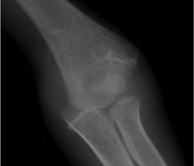 Distal Humerus Physeal Separation 2